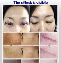 Load image into Gallery viewer, SCAR REMOVAL OIL