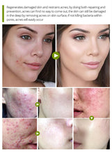 Load image into Gallery viewer, TEA TREE CREAM FOR ACNE