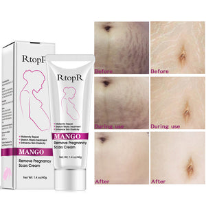 Stretch Mark Removal Cream